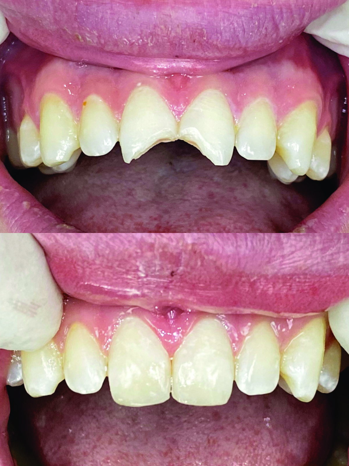 Before after Composite Veneer