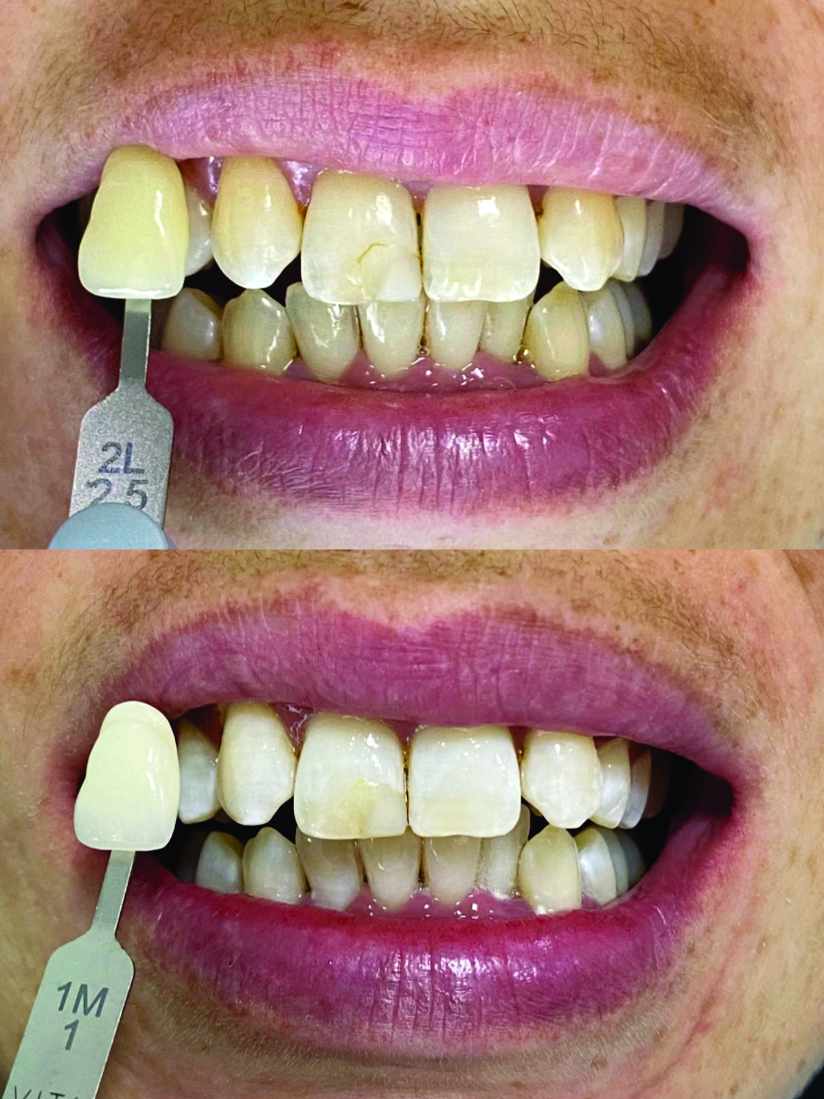 Before after Teeth Bleaching