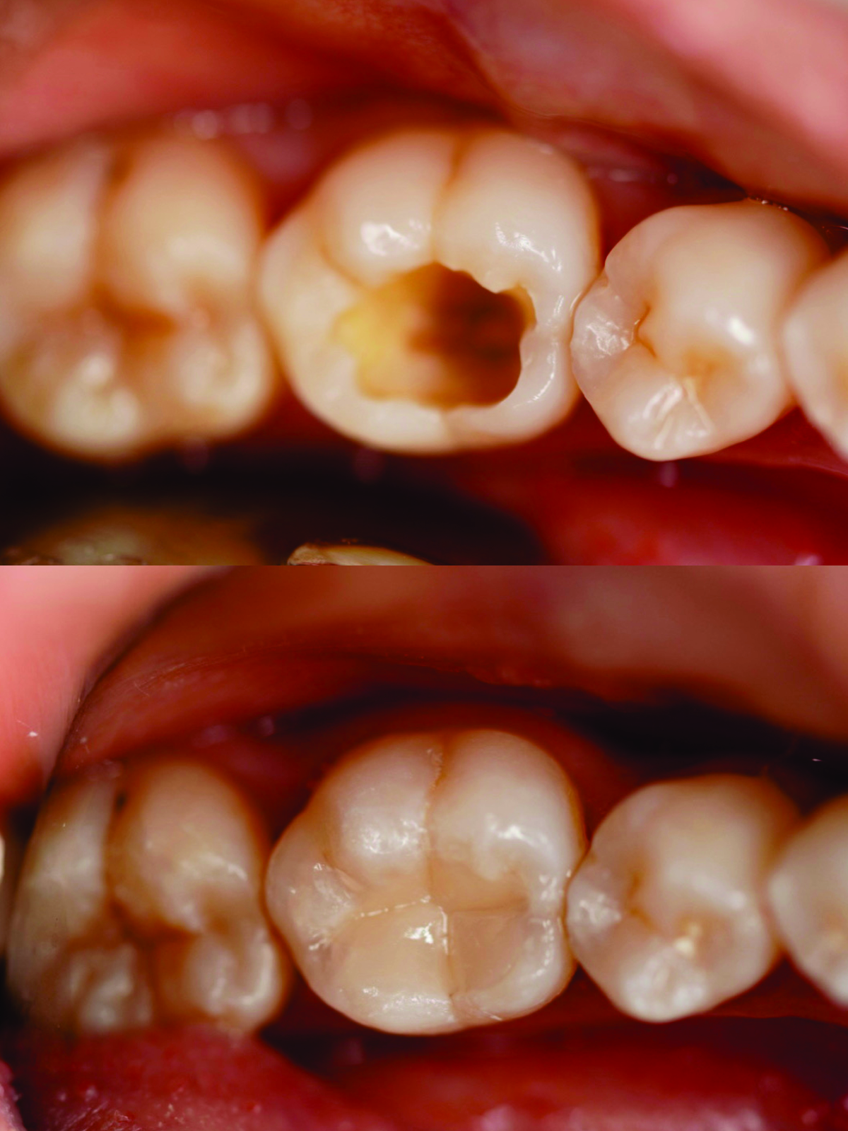 Before after Dental Filling
